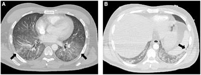 Severe ARDS due to disseminated toxoplasmosis in a person with HIV successfully treated with ECMO: a case report